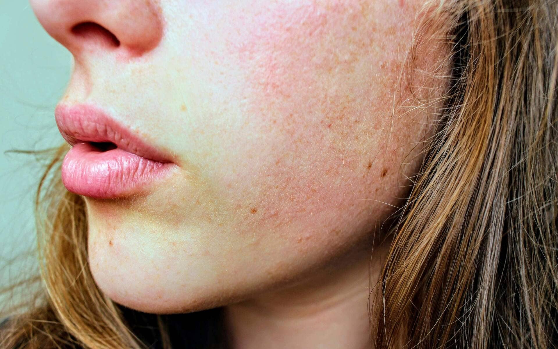 Cold-Sores-and-Stress.jpg