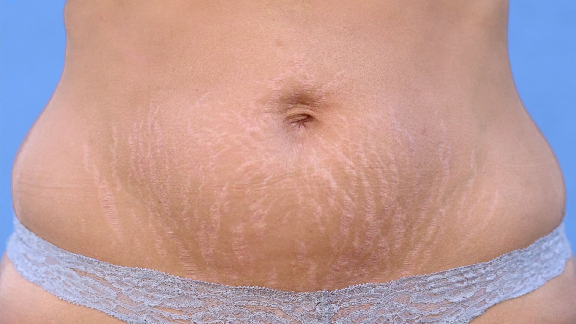 Postpartum Body